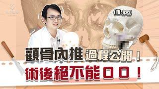 顴骨削骨後遺症多？術後照顧麻煩？上削骨解決「骨感」問題！｜依心唯美 謝東穎醫師