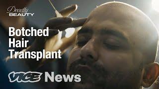 Indian Men Are Risking Lives To Avoid Going Bald | Deadly Beauty