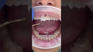 Smile Transformation With Composite Bonding Veneers | Before And After