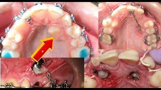 10 RARE cases of ORTHODONTIC IMPACTIONS! Timelapse of more than 300 photos.