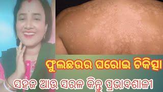 Home Treatment Of Tinea Versicolor{ଫୁଲଛଉର ଘରୋଇ ଚିକିତ୍ସା }@monisatipstricks