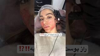 رازش میکرونیدلینگ ‼️پوست شفاف شیشه ای میخوای نرم و لطیف روش مناسبیه#میکرونیدلینگ #پوست_زیبا #پوست