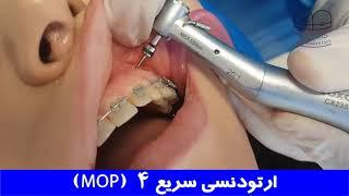 ارتودنسی سریع 4 (MOP) | دکتر احسان ابوئی مهریزی