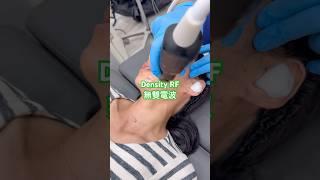 no numbing, no needles, and no downtime. #無雙電波 #kbeauty #density #densityrf