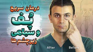 درمان پف و سیاهی زیر چشم | How to get rid of eye bags