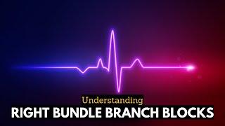 RBBB Uncovered: Navigating the Complexities of Right Bundle Branch Blocks