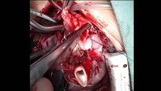 Expanding the Limits of Posterior Aortic Translocation Video 1