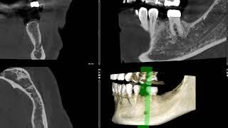 Implant #20 CBCT analysis