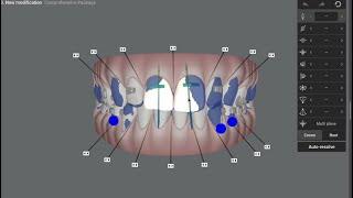 Modifying Invisalign Clincheck- Tips for excellent finishing and smile design