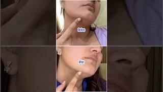 Look What This Serum Did To My Skin!
