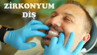 What is Zirconium Dental Veneer? (Benefits and Harms) Dr.Hakan Özden