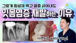 #잇몸염증 으로 발치진단 받고 치아 포기해야 하나 고민 될때 알고 결정하는 것과 모르고 결정하는 것은 내 치아의 미래가 달린 문제살려 쓰는 정직한 이유 #치과일타 #닥터꼬집