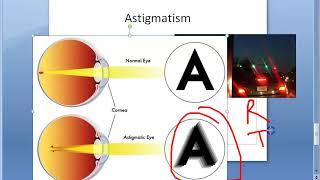 Ophthalmology 044 a Refractive Errors Of Refraction Emmetropia Ametropia Myopia HyperMetropia Eye