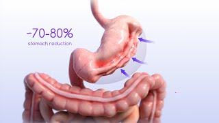 Endoscopic Gastric Sleeve (ESG) Procedure Animation - apolloendo.com/esg