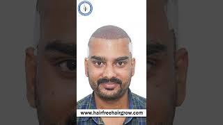 Best Hair Transplant in Mumbai | N/W Grade 6 | 4290 Grafts | Cost of Hair Transplant in Mumbai