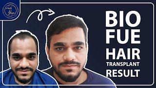 Natural Hair Transplant Result | Best Clinic In Mumbai | The Hair & Shape Clinic | Dr Umang Kothari