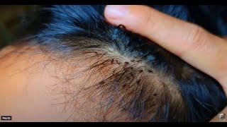 Picking a thousand of lice on hair   How to get rid of lice #hair #wigs  #skincare #satisfying