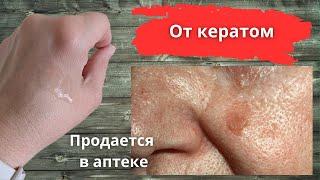 Легко и безопасно убрать кератомы без рубцов и шрамов