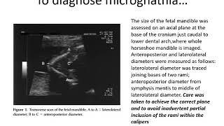 Micrognathia , Retrognathia , Jaw index, inferior facial line