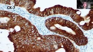 Tip-135;Primary Ovarian Mucinous Carcinoma