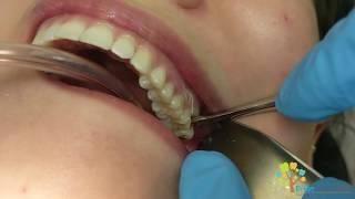 Wisdom Tooth Extraction In Under 3 Minutes