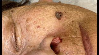 Seborrheic Keratosis Removal