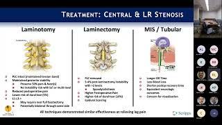 Neurogenic Claudication & Lateral Recess Stenosis : Rick Lang, MD on August 15, 2022.