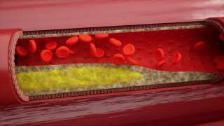 Arteriosclerosis - How fat and cholesterol restricts blood flow