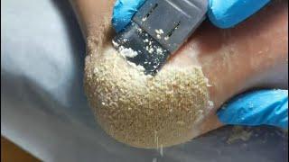 This is for lover of cheese. Cracked heel treatment & Callus removal. Dead skin removal. Foot care.