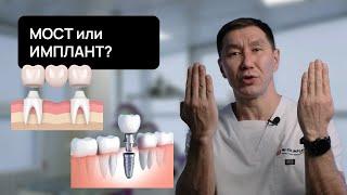 Мостовидный ПРОТЕЗ или ИМПЛАНТ? Какие последствия каждого выбора?