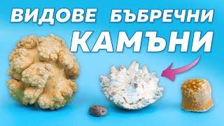 Кои са най-честите видове камъни в бъбреците?