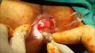 Rectal prolapse with prolapsed Bleeding Piles