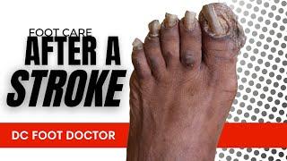 FOOT CARE AFTER A STROKE