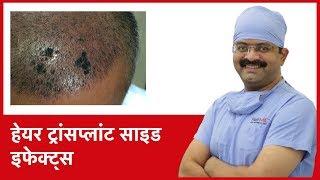 What Are The Side Effects Of Hair Transplant (हेयर ट्रांसप्लांट साइड इफेक्ट्स) | (In HINDI)