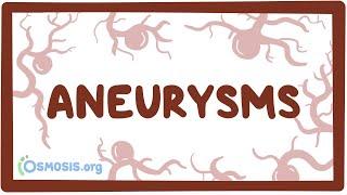 Aneurysms - causes, symptoms, diagnosis, treatment, pathology