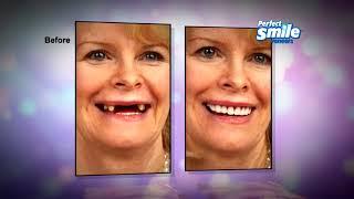 Perfect Smile Veneers