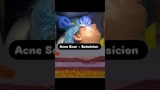 Acne Scar- Subsicion #dranvika #cosmeticdermatology #acnescartreatment