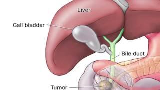 What is the Whipple Procedure - Mayo Clinic