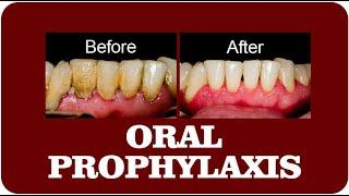 Oral Prophylaxis and Scaling: Essential Dental Procedures for Healthy Teeth