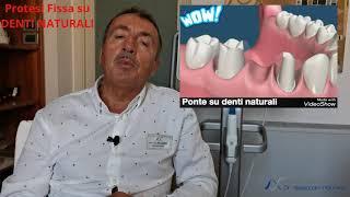 Protesi Fissa e Ponti su denti naturali