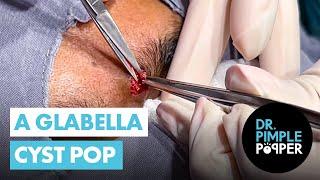 A Glabella Cyst Pop