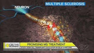 Promising Stem Cell Therapy For Multiple Sclerosis