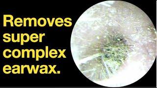 Removes super complex earwax. |ear wax removal | ear cleaning | ASMR | relaxation | relax