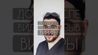 Виниры на зубы, видео отзыв и результат До/После