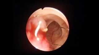 Colonoscopy - polypectomy from colon