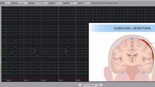 EEG of a Patient With Subdural Hematoma