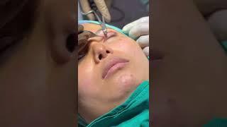 Double Eyelid Live procedure #shortsfeed #shorts