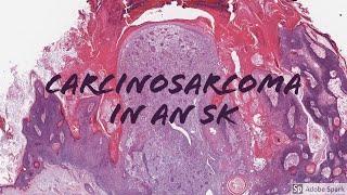 Carcinosarcoma Arising from Seborrheic Keratosis