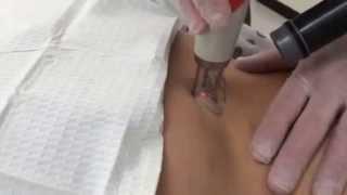 Laser Tattoo Removal Procedure With The Quanta Q-Plus C