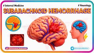 14. Subarachnoid Hemorrhage Explained  | Thunderclap Headache and Clinicals | NEET PG/FMGE/USMLE